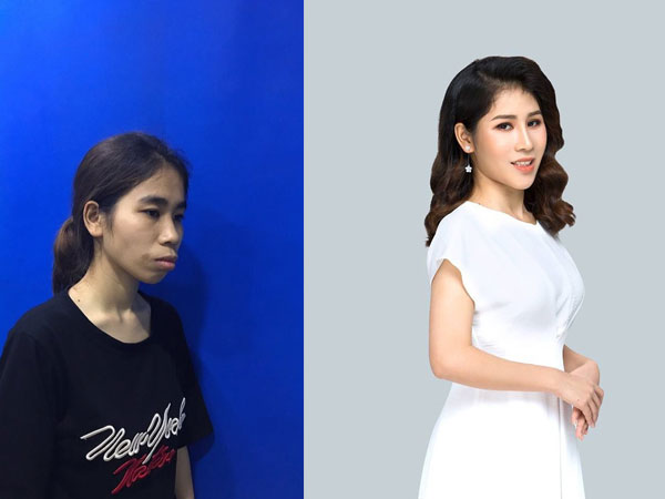 Bị chê 'ăn đu đủ không cần thìa', cô gái quyết tâm 'lột xác' và thành quả bất ngờ khiến mẹ chỉ có thể nhận ra con gái qua vết sẹo