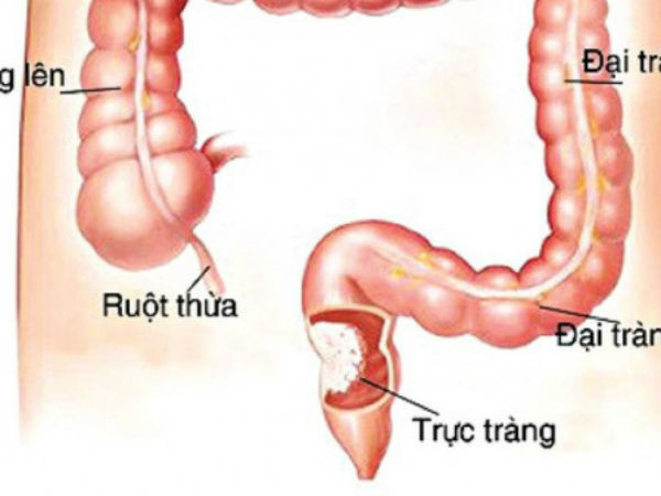 Tỷ lệ mắc ung thư ruột tăng 50% sau 10 năm: 3 yếu tố gây bệnh nhiều người đang 'coi nhẹ'