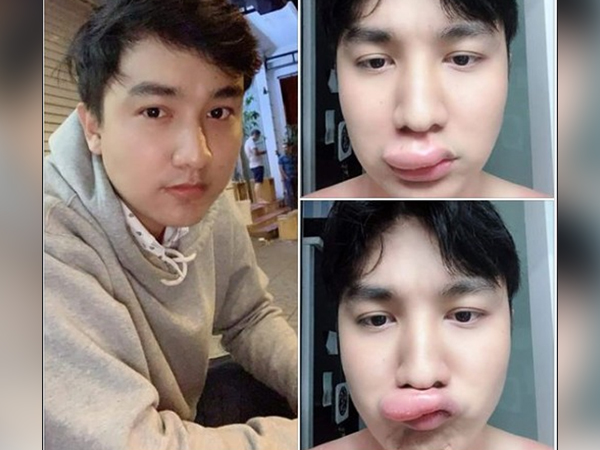 Kể khổ bị dị ứng thuốc, môi sưng tều đúng ngày đầu năm 2019, nam thanh niên lại được chú ý rần rần bởi nhan sắc thực sự phía sau