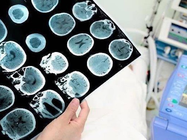 Người đàn ông bị nhồi máu não đột ngột, bác sĩ nói nguyên nhân liên quan đến 2 thói quen rất nhiều người cũng mắc