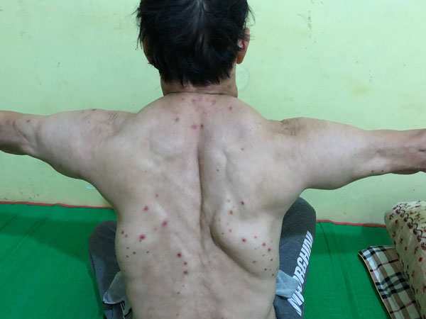 Uống rượu nhiều năm, 3 người đàn ông mắc bệnh lạ, khối u khủng mọc chi chít