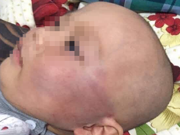 Vụ bé trai 19 tháng tuổi bị bảo mẫu tát sưng mặt: Gia đình không chấp nhận lời xin lỗi