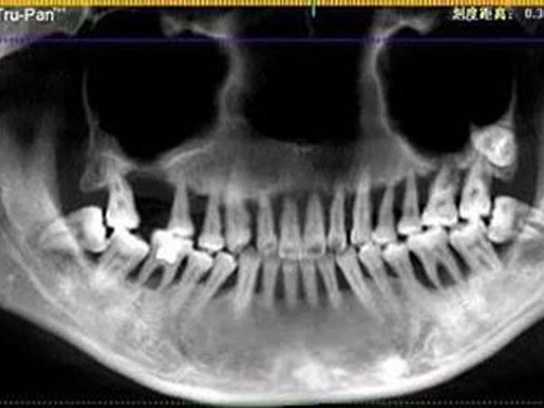 Cô gái 28 tuổi rụng răng, móm mém như cụ bà 80 vì thói quen xấu