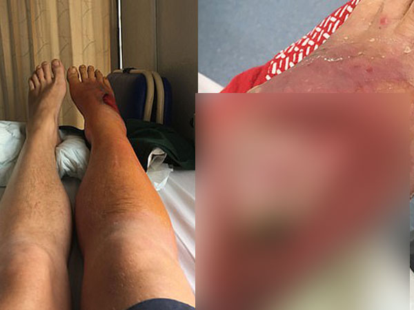 Rùng mình, bác sĩ thả 400 con giòi vào chân để ăn thịt chữa bệnh