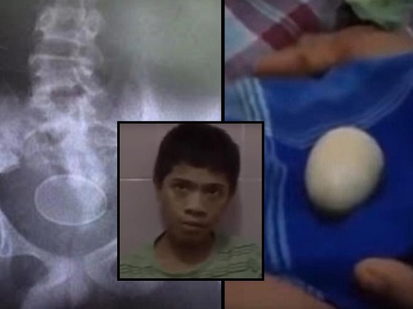KHÓ TIN: Cậu bé người Indonesia đẻ 20 quả trứng đều đặn trong 2 năm