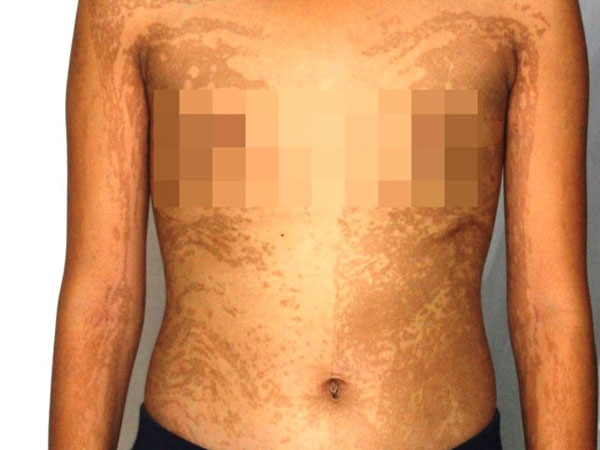 Bé gái An Giang là người đầu tiên trên thế giới mắc hai bệnh da hiếm gặp