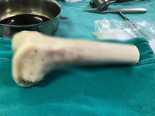 Nữ giáo viên 36 tuổi bị khối u ăn mục xương mà không biết