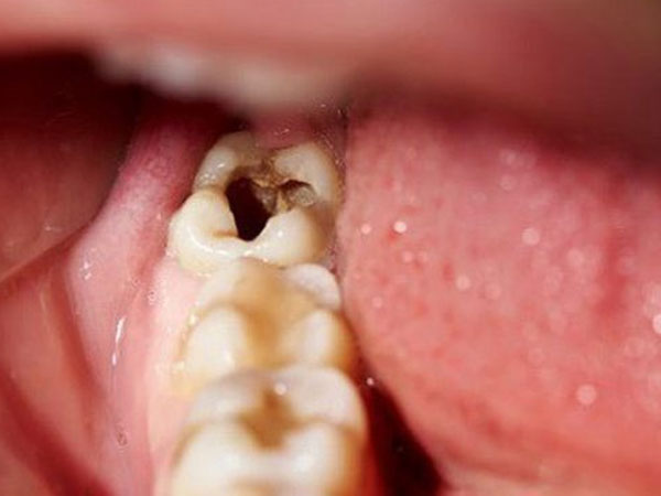 Người phụ nữ ở Phú Thọ suýt chết khi chữa sâu răng