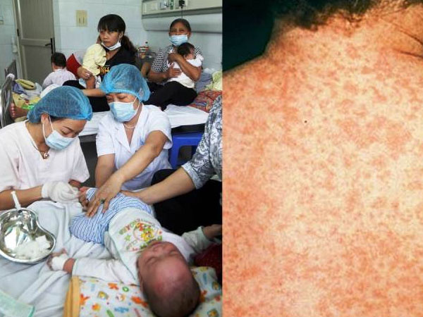 Hà Nội: Thêm 23 ca mắc sởi, không tiêm vắc xin dễ mắc bệnh