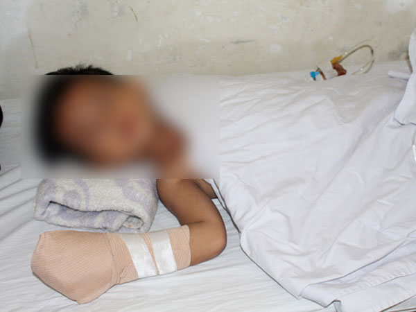 Hai cháu bé bị pháo nổ làm nát bàn tay