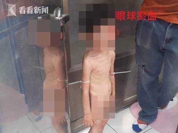 Phẫn nộ cậu bé 3 tuổi bị bố và người tình bạo hành mỗi ngày, đói tới mức phải lấy phân để ăn