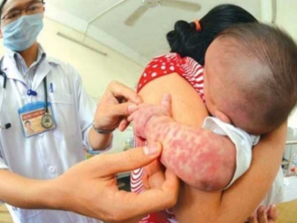 Cảnh báo: Một tuần Hà Nội ghi nhận 78 trường hợp mắc sởi