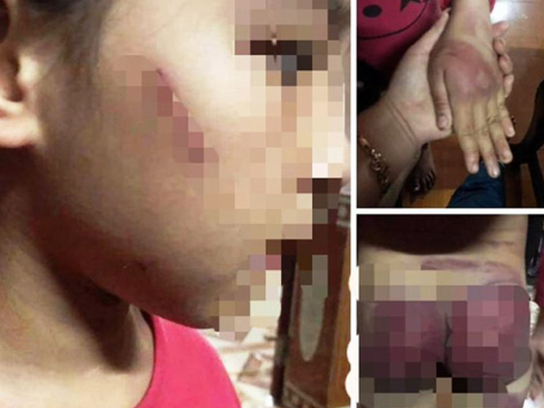 Mẹ rớt nước mắt thấy con gái 8 tuổi bị bố bạo hành thâm tím khắp người