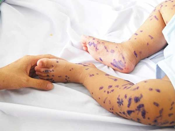TS.BS BV Nhi Trung ương: 4 lưu ý khi chăm sóc thủy đậu tại nhà, tránh biến chứng