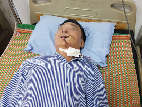 Tưởng bị nhiệt miệng, người đàn ông Hà Nội phải cắt 1 góc má vì ung thư