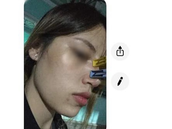 Muốn đẹp không tốn kém, cô gái trẻ tin lời 'chị em cây khế' tư vấn dùng kẹp quần áo để nâng mũi