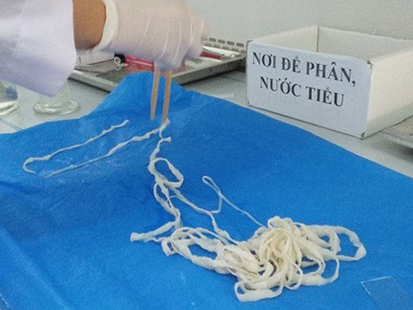 'Bắt' sán dây dài hơn 5 m khỏi cơ thể nữ giáo viên
