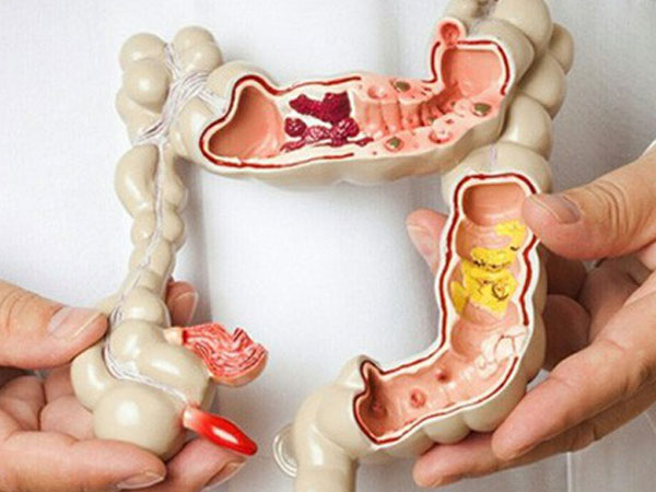 Người phụ nữ 26 tuổi bị ung thư: Bác sĩ cảnh báo có những phương pháp giảm cân ngàn vạn lần không nên lạm dụng