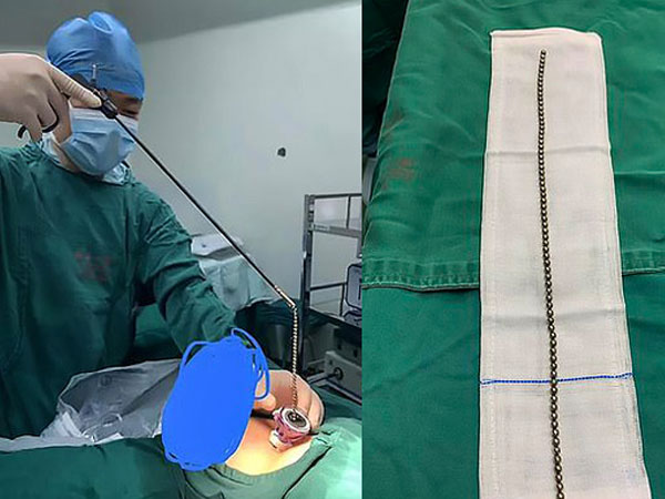 Cậu bé 11 tuổi nhét chuỗi 70 viên bi vào ‘cậu nhỏ’