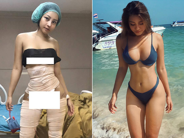 Hot girl bốc lửa Thái Lan bất ngờ công khai ảnh phẫu thuật để có eo con kiến, điều đáng nói đây không phải lần đầu cô lột xác
