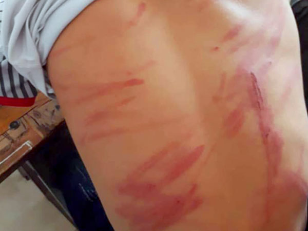 Hà Tĩnh: Nghi bị bố ruột đánh bầm tím người, nam sinh lớp 8 đến trường hoảng sợ rồi ngất xỉu