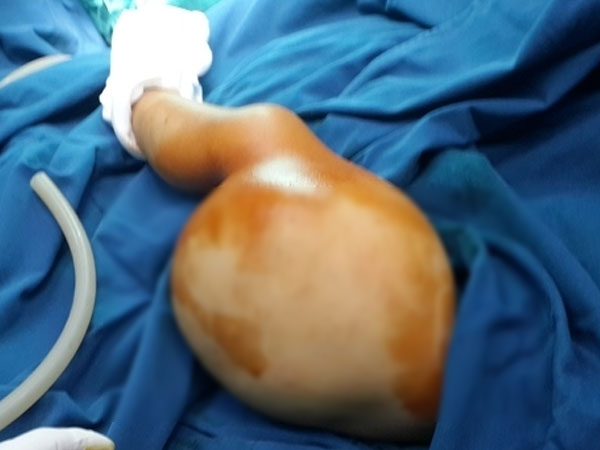 Bé trai Thanh Hoá mọc khối u khổng lồ ở đùi do lỗi của mẹ khi mang bầu