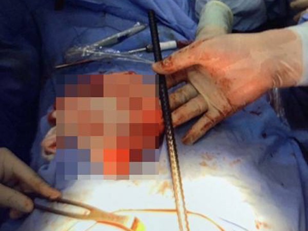 Lâm Đồng: Phẫu thuật thành công, lấy thanh sắt dài 65cm đâm xuyên ngực bệnh nhân