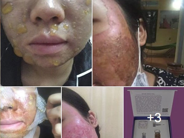 Kinh hãi hình ảnh cô gái bị nổi bóng nước khắp mặt vì làm đẹp: Chuyên gia cảnh báo điều quan trọng trước khi peel da