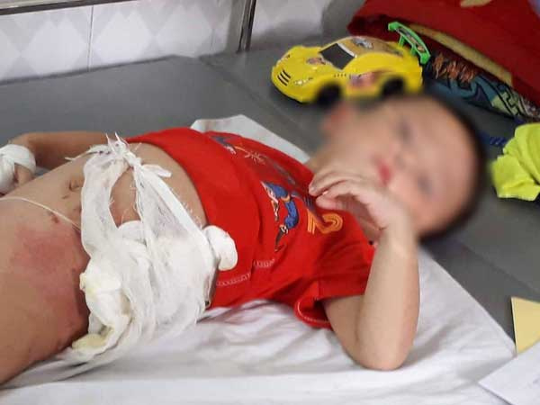 Người cậu ném cháu ruột vào đống lửa đã bị bắt, nạn nhân có thể phải chuyển lên tuyến trung ương điều trị