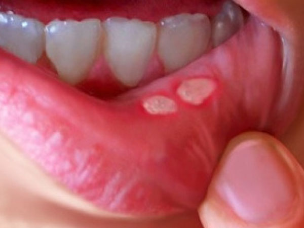 12 cách chữa nhiệt miệng