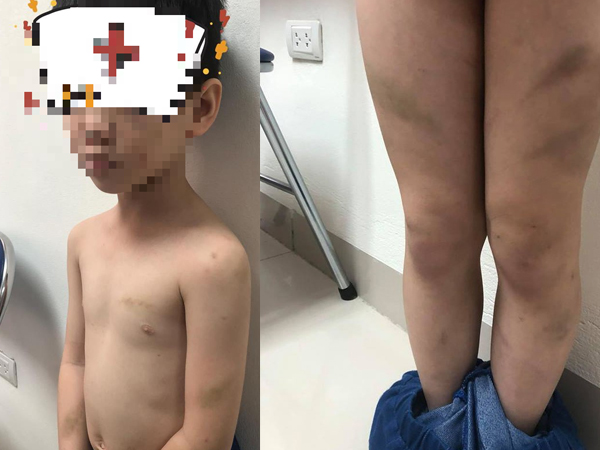 Hà Nội: Mẹ ruột tố con trai lớp 1 bị mẹ kế bạo hành bằng dép và gậy khiến bé bầm tím cả người
