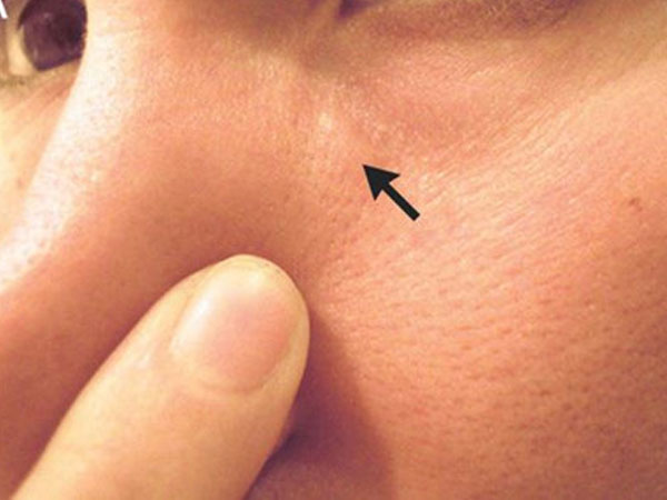 Người đàn ông suýt mù vì giun chỉ dài 15 cm ký sinh trong mắt