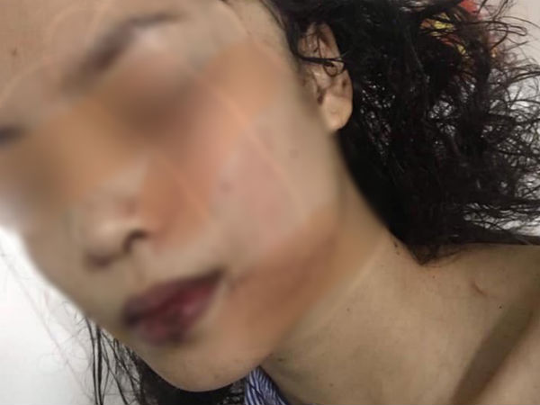 Bắc Ninh: Cô gái 18 tuổi bị bạn cũ lao vào phòng rạch mặt, cổ và tay, phải khâu 60 mũi
