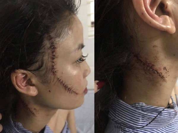 Chị gái thiếu nữ xinh đẹp bị rạch mặt: 'Em tôi kêu có thai mà họ vẫn không tha'
