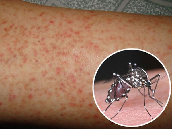 Nghĩ ngay đến mắc bệnh sốt xuất huyết nếu có những dấu hiệu này