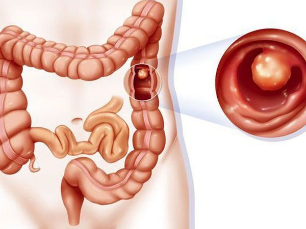 Loại đồ uống ưa thích gây ra 230 bệnh, 8 loại ung thư ở người Việt