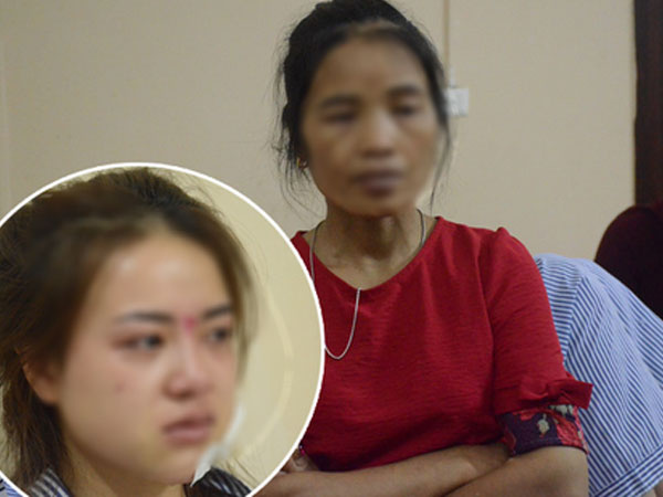 Bố mẹ của cô gái rạch mặt thiếu nữ khâu 60 mũi: 'Nhìn vết thương của con mà tôi sốc, cứ tưởng nó bị tai nạn'