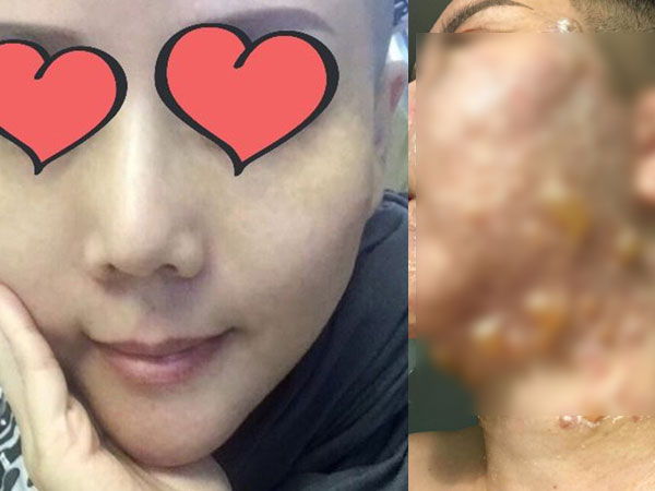 'Phẫu thuật' căng da mặt khiến cả khuôn mặt người phụ nữ bị bao phủ trong những vết phồng rộp kinh hoàng