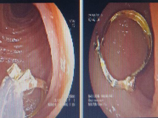 Bé gái 1 tuổi suýt chết vì tổn thương dạ dày vì giật khuyên tai từ bạn và nuốt