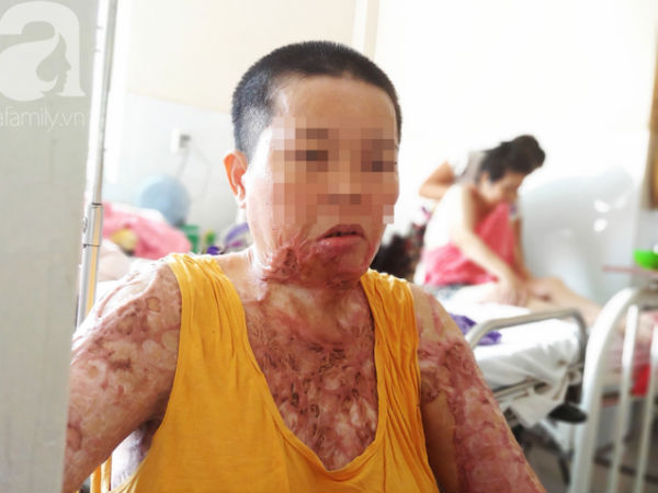 Người phụ nữ bị tình cũ tạt axit bỏng nặng sau khi níu kéo tình cảm không thành