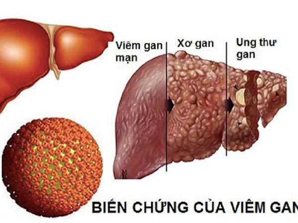 Viêm gan B lây lan nhanh hơn HIV gấp 100 lần, dùng chung bát đũa có lây?