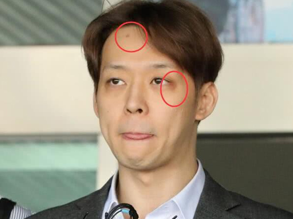Yoochun dùng ma túy xong đập đầu vào tường, dấu vết còn y nguyên trên trán trong ngày bị còng tay?