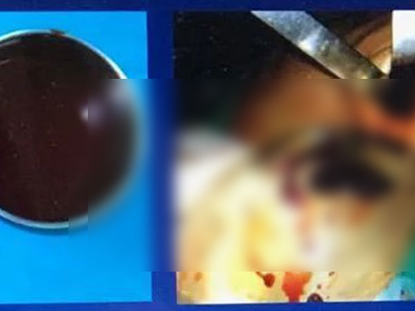 Ngực nữ doanh nhân Việt 33 tuổi sưng to như muốn nổ tung sau thẩm mĩ