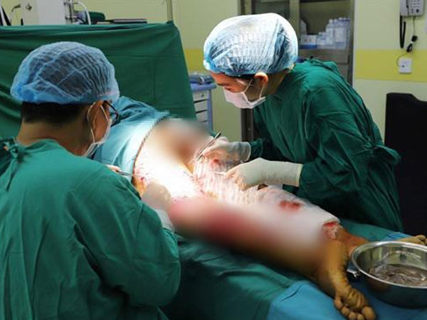 Không để ý vết xước ở tay khi làm thịt lợn, người phụ nữ bị suy đa tạng nghiêm trọng