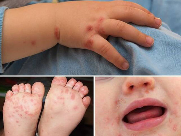 Trong 1 tuần có thêm 14 ca mắc tay chân miệng: Đây là dấu hiệu bệnh tay chân miệng và việc cha mẹ cần làm ngay để phòng bệnh cho con