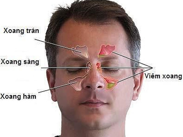 Chỉ đau đầu, giảm thị lực, đi khám đã phát hiện ung thư 'ăn' vào não