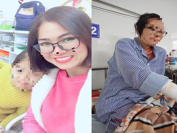 1 năm sau khi bị chồng cũ tạt axit, cô giáo Hà Nội xinh đẹp kể về 5 ngày chết lâm sàng, 21 lần ghép da