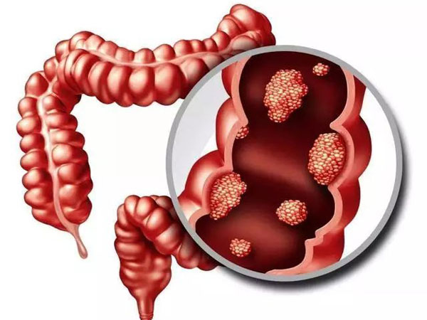 Bác sĩ cảnh báo 2 loại 'đau' báo hiệu ung thư ruột, 4 kiểu người nên đi khám sớm
