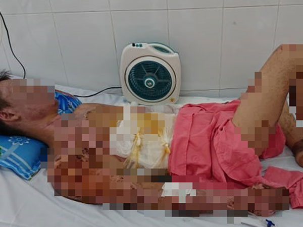 Thương tâm: Chuẩn bị ăn cơm thì nổ bình gas, cả gia đình 4 người bỏng nặng