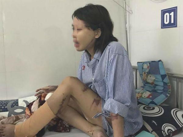 Vụ cô gái bị tạt axit: Bác sĩ ám ảnh vì một nửa khuôn mặt cháy đen